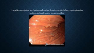 Los pólipos gástricos son lesiones elevadas de origen epitelial cuya patogénesis e
historia natural no son bien conocidas.
 