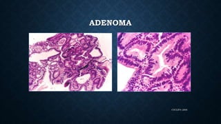 CICLIPA 2006
ADENOMA
 