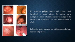 • El término pólipo deriva del griego poli
(muchos) y pous (pies). Se aplica para
cualquier tumor o tumefacción que surge de la
mucosa del intestino, ya sea pedunculado o
sésil.
• Poliposis: éste término se utiliza cuando hay
más de 10 pólipos.
 