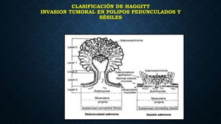 CLASIFICACIÓN DE HAGGITT
INVASION TUMORAL EN POLIPOS PEDUNCULADOS Y
SÉSILES
 