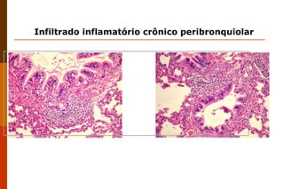 Infiltrado inflamatório crônico peribronquiolar                                                                                                                                                                         