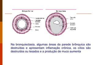 Na bronquiectasia, algumas áreas da parede brônquica são destruídas e apresentam inflamação crônica, os cílios são destruídos ou lesados e a produção de muco aumenta  