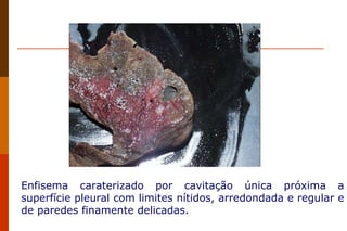 Enfisema caraterizado por cavitação única próxima a superfície pleural com limites nítidos, arredondada e regular e de paredes finamente delicadas.  