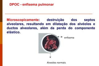 Microscopicamente : destruição dos septos alveolares, resultando em dilatação dos alvéolos e ductos alveolares, além da perda do componente elástico. DPOC -  enfisema pulmonar  Alveolos normais enfisema 