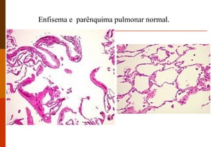 Enfisema e  parênquima pulmonar normal. 