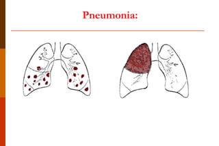 Pneumonia:  