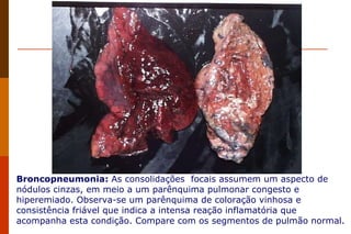 Broncopneumonia:  As consolidações  focais assumem um aspecto de nódulos cinzas, em meio a um parênquima pulmonar congesto e hiperemiado. Observa-se um parênquima de coloração vinhosa e consistência friável que indica a intensa reação inflamatória que acompanha esta condição. Compare com os segmentos de pulmão normal. 
