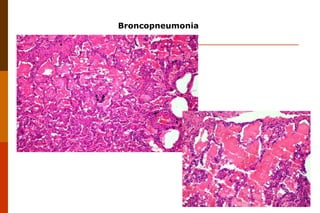 Broncopneumonia 