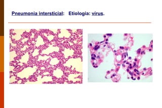 Pneumonia intersticial :  Etiologia:  vírus .  