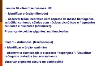 Lamina 76 – Necrose caseosa. HE  -   identificar o órgão (lifonodo)  -   observar lesão  necrótica com aspecto de massa homogênea, acidófila, contendo células com núcleos picnóticos e fragmentos celulares e nucleares (cariorrexe).  Presença de células gigantes, multinucleadas  Peça 1 – Antracose. (Macroscopia)  -    identificar o órgão  (pulmão) -    observar a elasticidade e o aspecto “esponjoso”.  Visualizar brônquios cortados transversalmente. observar pigmento escuro no parênquima  