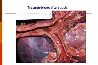 Traqueobronquite aguda 