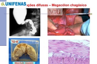 Dilatações difusas – Megacólon chagásico 