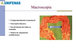 Macroscopia Comprometimento transmural Ulcerações lineares Envolvimento de todas as camadas Pedras de calçamento (cobblestone) 