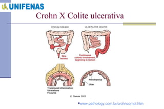 Crohn X Colite ulcerativa www.pathology.com.br/crohncompl.htm   