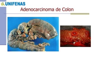 Adenocarcinoma de Colon 