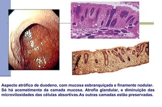 Aspecto atrófico de duodeno, com mucosa esbranquiçada e finamente nodular. Só há acometimento da camada mucosa. Atrofia glandular, e diminuição das microvilosidades das células absortivas.As outras camadas estão preservadas. 