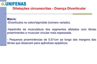 Dilatações circunscritas - Doença Diverticular Macro :  Divertículos no colon/sigmóide (número variado). -hipertrofia da musculatura dos segmentos afetados com tênias proeminentes e muscular circular mais espessada. - Pequenas proeminências de 0,5/1cm ao longo das margens das tênias que dissecam para apêndices epiplóicos. 