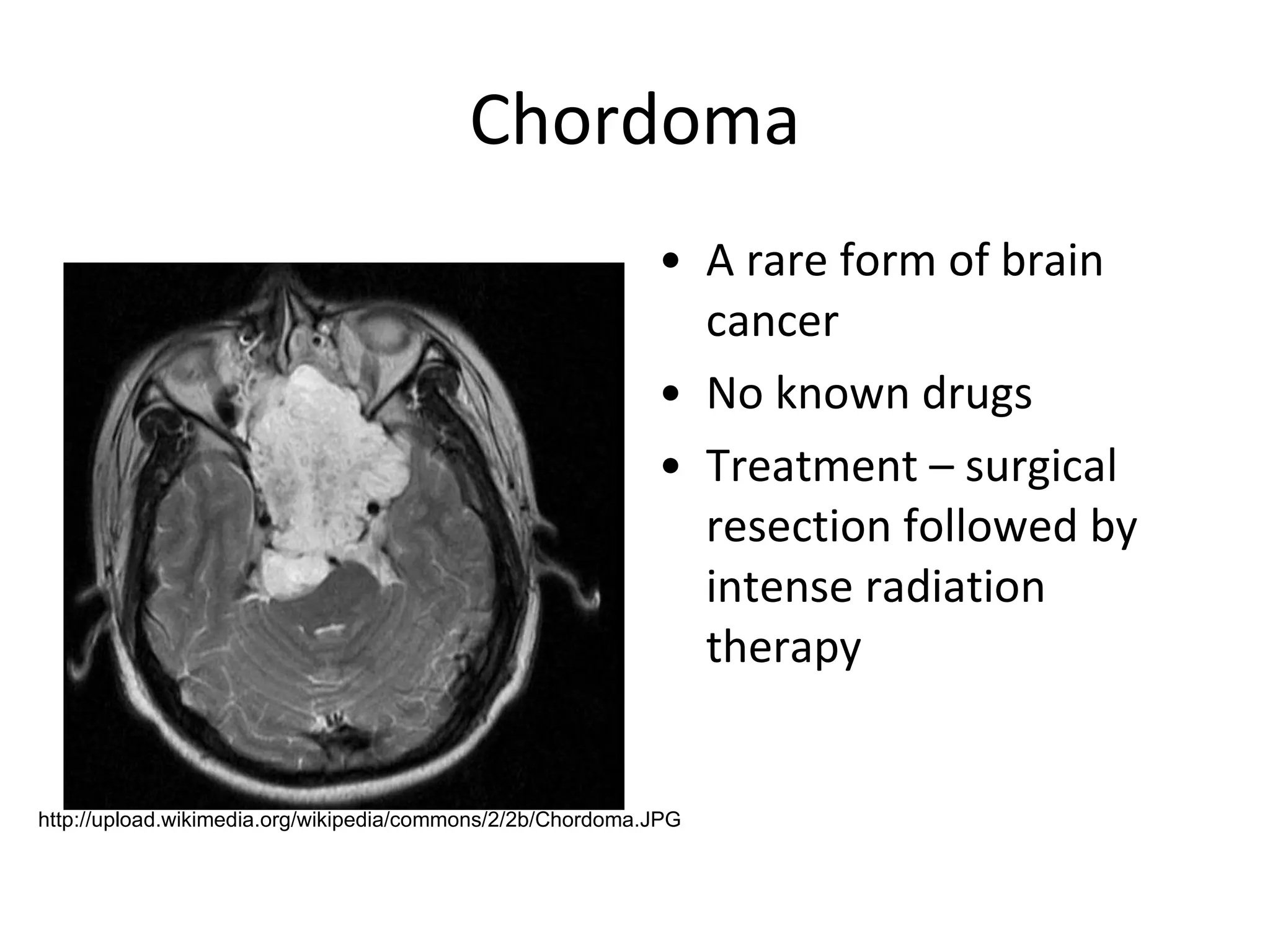 Chordoma A rare form of brain cancer No known drugs Treatment – surgical resection followed by intense radiation therapy http://upload.wikimedia.org/wikipedia/commons/2/2b/Chordoma.JPG 