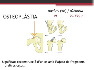 OSTEOPLÀSTIA

ὀστέον (τό) / πλάσσω
os
corregir

Significat: reconstrucció d’un os amb l’ajuda de fragments
d’altres ossos.

 
