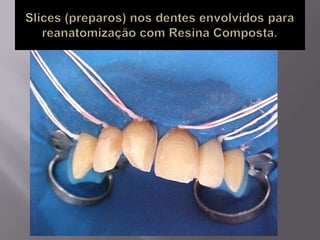 Plástica dental