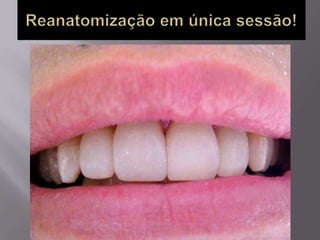 Plástica dental
