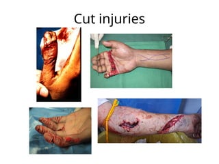 Cut injuries
 