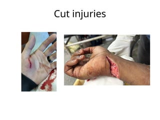 Cut injuries
 