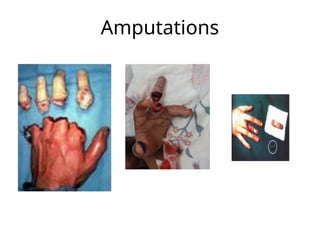 Amputations
 
