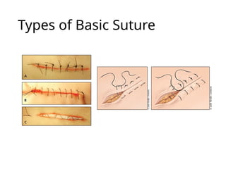 Types of Basic Suture
 