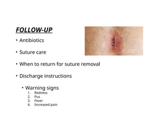 FOLLOW-UP
• Antibiotics
• Suture care
• When to return for suture removal
• Discharge instructions
• Warning signs
1. Redness
2. Pus
3. Fever
4. Increased pain
 