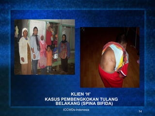 KLIEN ‘H’
KASUS PEMBENGKOKAN TULANG
    BELAKANG (SPINA BIFIDA)
      ICCWDs-Indonesia
                              14
 
