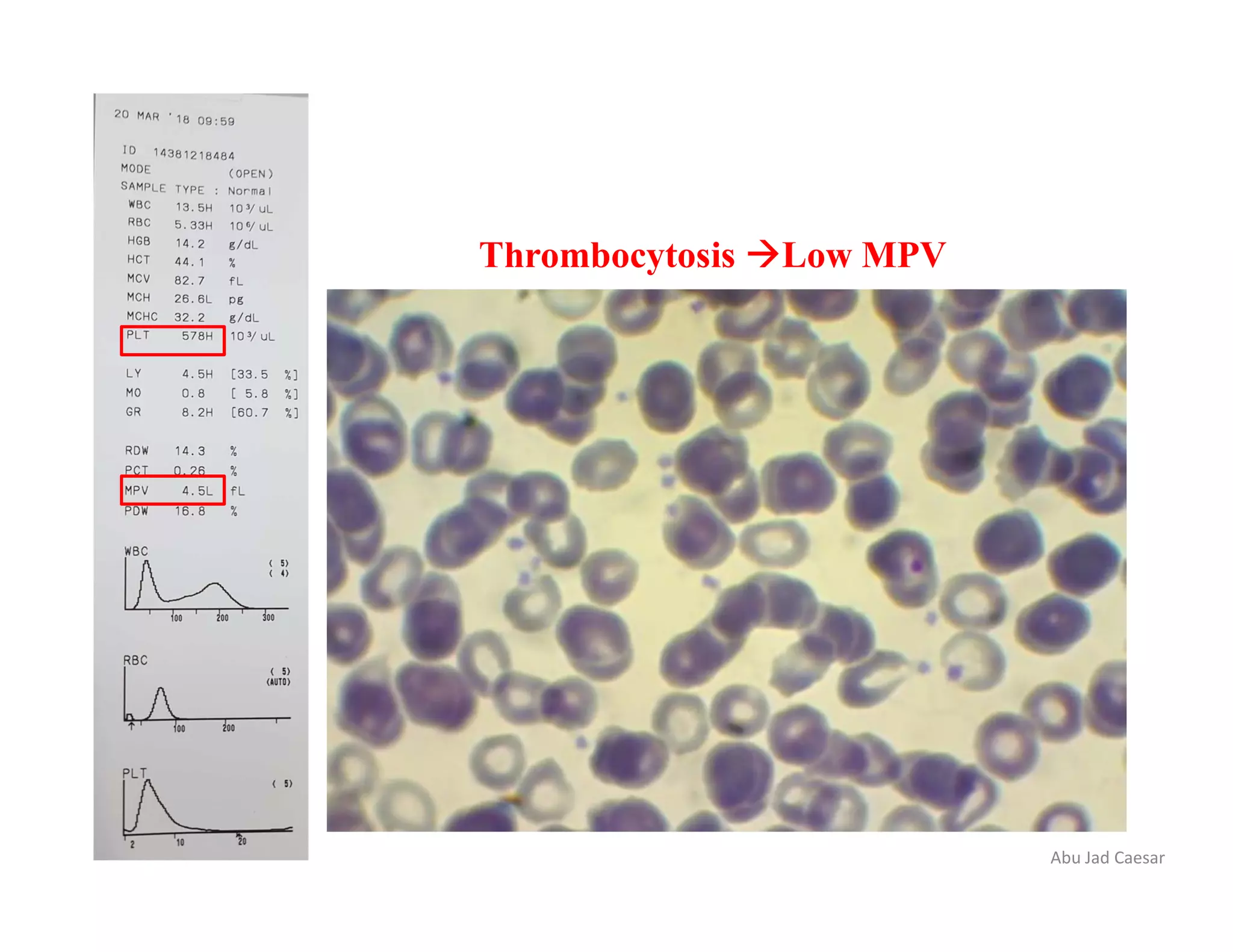 Abu Jad Caesar
Thrombocytosis Low MPV