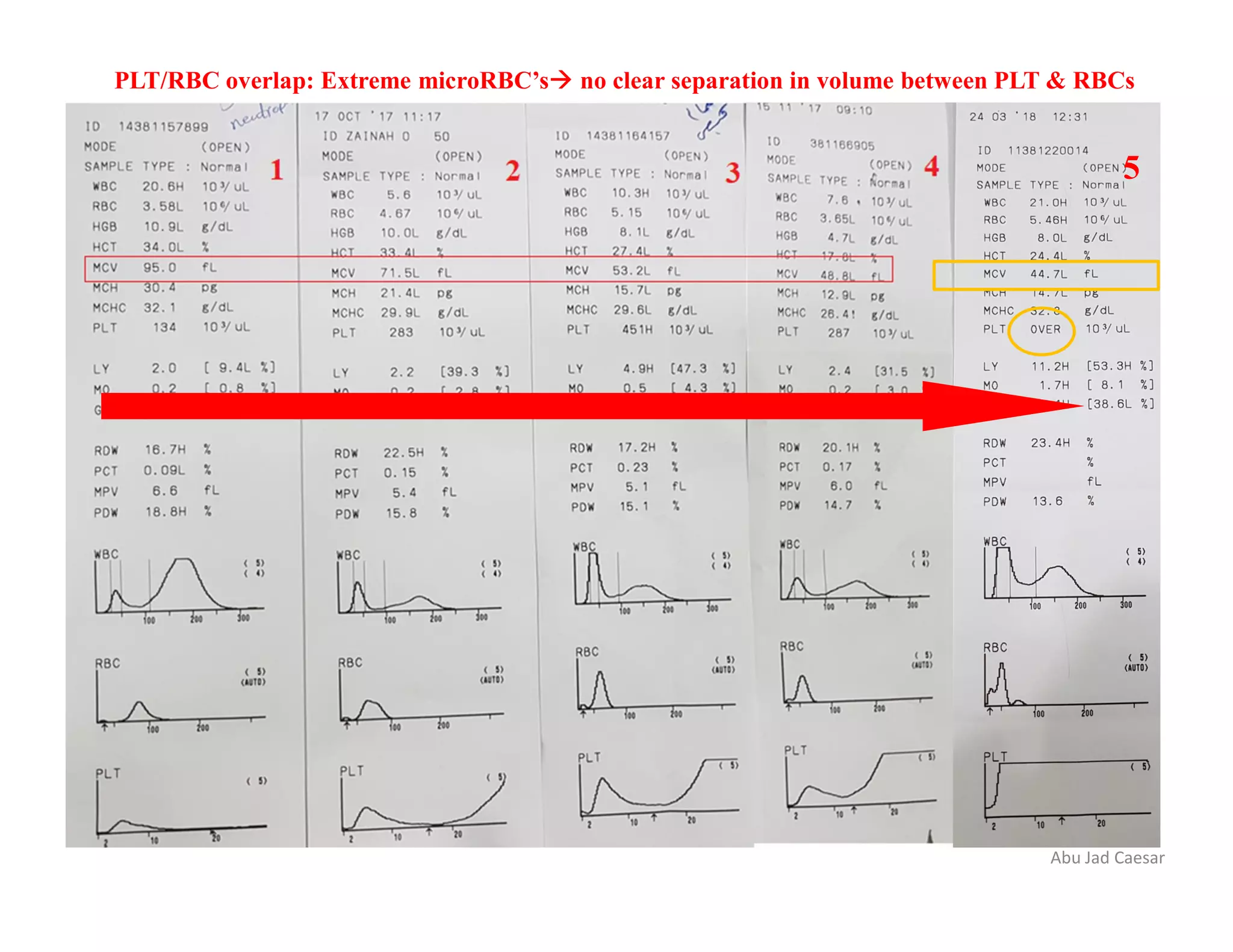 PLT/RBC overlap: Extreme microRBC’s no clear separation in volume between PLT & RBCs
Abu Jad Caesar
5