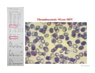 Abu Jad Caesar
Thrombocytosis Low MPV
 