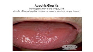 Atrophic Glossitis
burning sensation of the tongue, and
atrophy of lingual papillae produces a smooth, shiny red tongue dorsum
 
