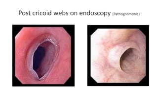 Post cricoid webs on endoscopy (Pathognomonic)
 