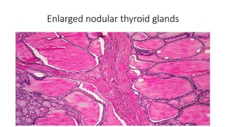 Enlarged nodular thyroid glands
 