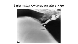 Barium swallow x-ray on lateral view
 