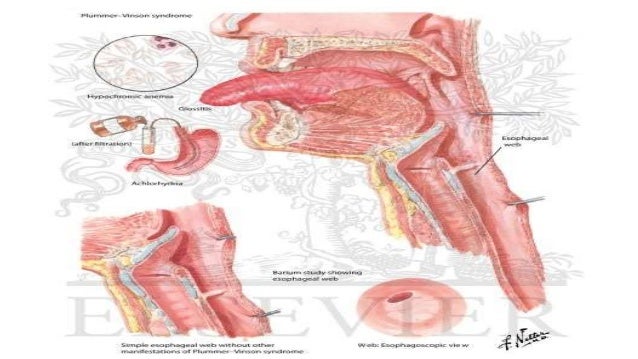 plummer vinson syndrome
