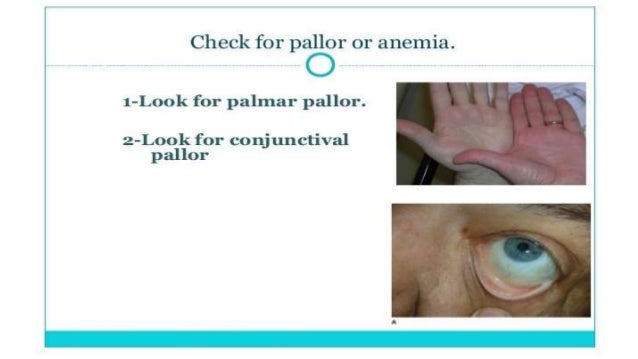 plummer vinson syndrome plummer vinson syndrome