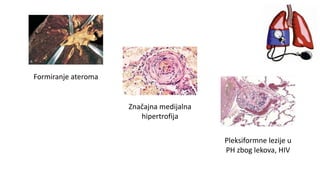 Formiranje ateroma
Značajna medijalna
hipertrofija
Pleksiformne lezije u
PH zbog lekova, HIV
 