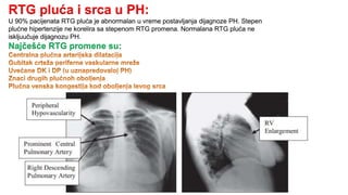 RTG pluća i srca u PH:
U 90% pacijenata RTG pluća je abnormalan u vreme postavljanja dijagnoze PH. Stepen
plućne hipertenzije ne korelira sa stepenom RTG promena. Normalana RTG pluća ne
iskljuučuje dijagnozu PH.
Najčešće RTG promene su:
 