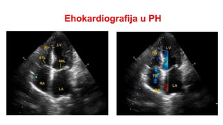 Ehokardiografija u PH
 