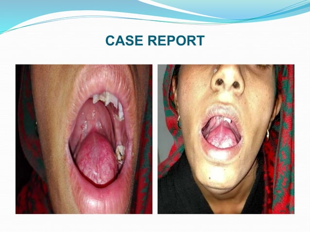 PLUNGING RANULA- A CASE REPORT.(Deep, diving or a cervical ranula ...