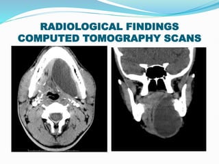 PLUNGING RANULA- A CASE REPORT.(Deep, diving or a cervical ranula) | PPTX