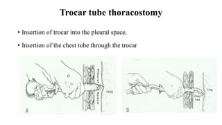 Trocar tube thoracostomy
• Insertion of trocar into the pleural space.
• Insertion of the chest tube through the trocar
 