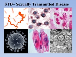 STD– Sexually Transmitted Disease
 