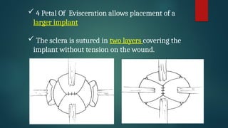 Enucleating ENUCLEATION_and_EVISCERATION.pptx BY Dr Ravindrakumar | PPTX