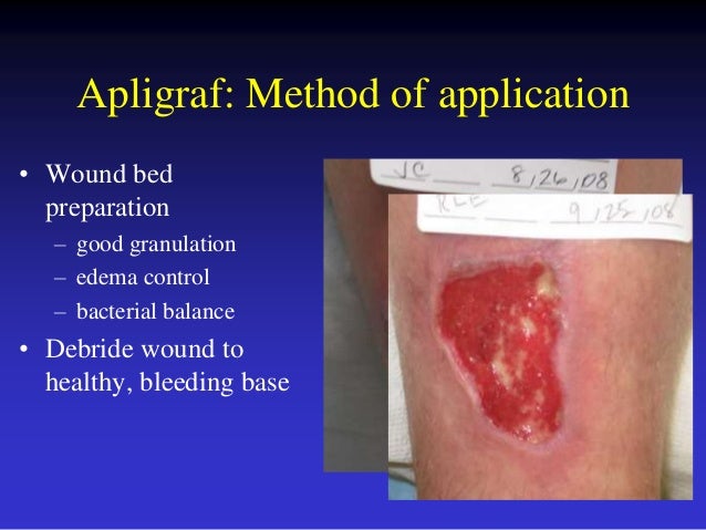 venous ulcers adjuvants bleeding