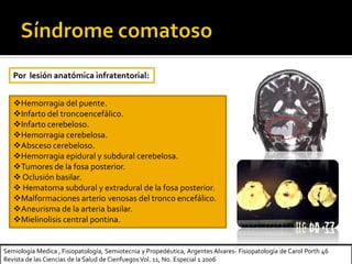 Semiología Medica , Fisiopatología, Semiotecnia y Propedéutica, Argentes Alvares- Fisiopatología de Carol Porth 46
Revista de las Ciencias de la Salud de Cienfuegos Vol. 11, No. Especial 1 2006
Hemorragia del puente.
Infarto del troncoencefálico.
Infarto cerebeloso.
Hemorragia cerebelosa.
Absceso cerebeloso.
Hemorragia epidural y subdural cerebelosa.
Tumores de la fosa posterior.
Oclusión basilar.
 Hematoma subdural y extradural de la fosa posterior.
Malformaciones arterio venosas del tronco encefálico.
Aneurisma de la arteria basilar.
Mielinolisis central pontina.
Por lesión anatómica infratentorial:
 
